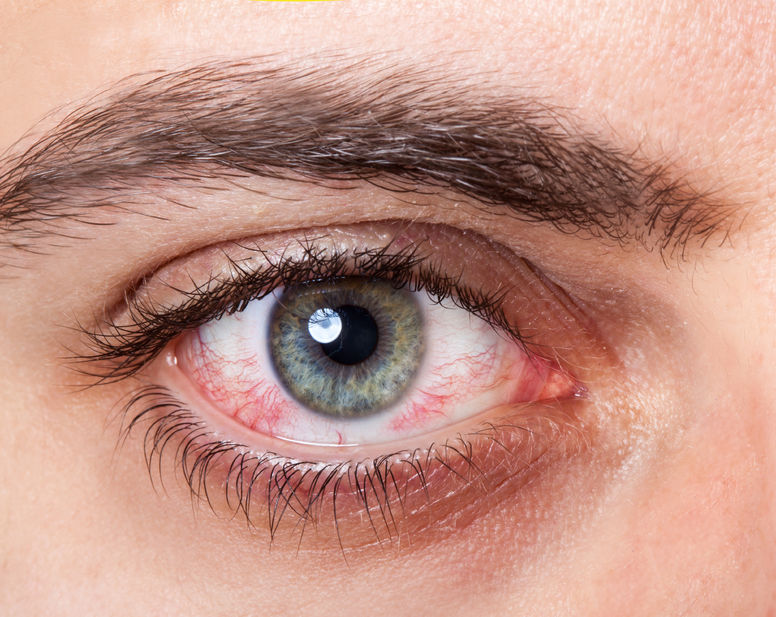 How to Treat Dry Eyes