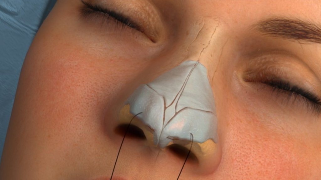 What Is Rhinoplasty