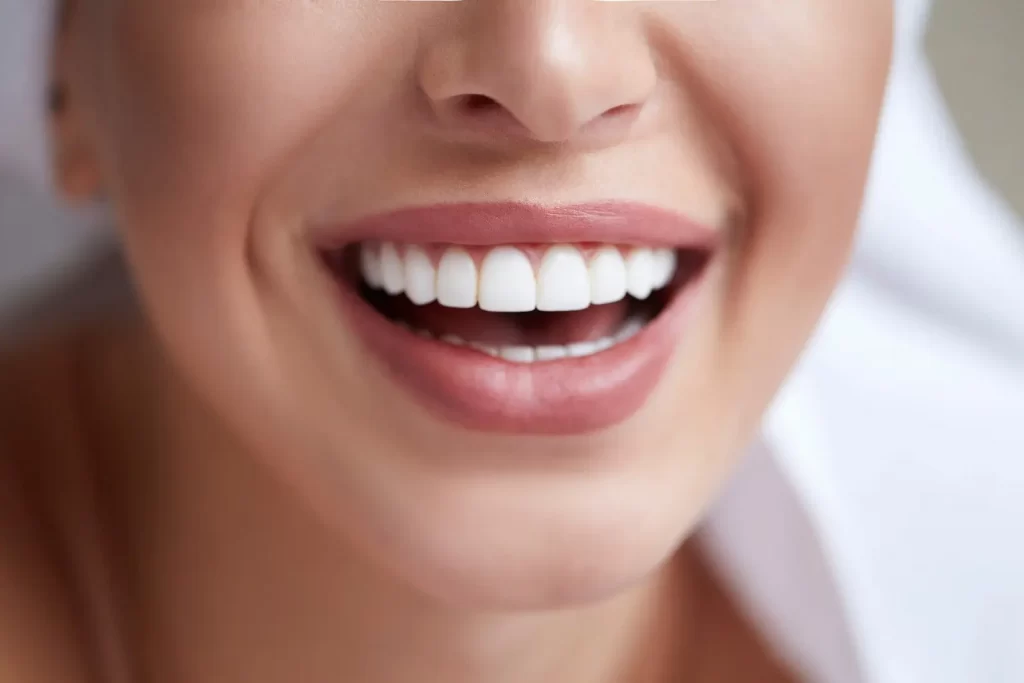 porcelain veneers