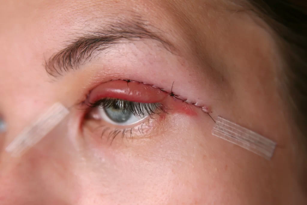 Eyelid Surgery