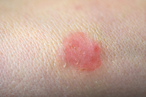 Essential Oils & Recipes For Ringworm