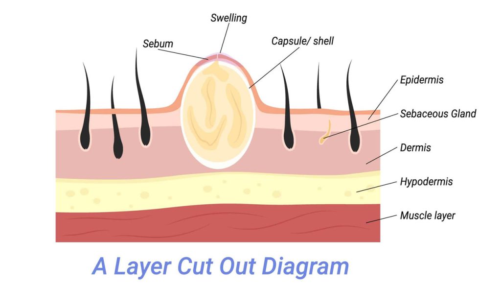 Milialar: Small Bumps Under The Skin Explained