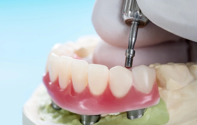 Revolutionizing Smiles_ The Latest Breakthroughs in Dental Implant Technology