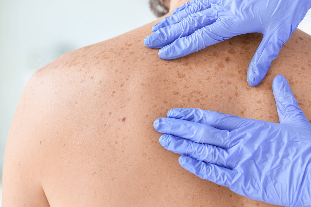Sunspots on Skin