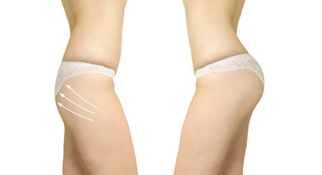 Brazilian Butt Lift (BBL) Surgery: What to Expect